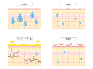 インナードライ肌